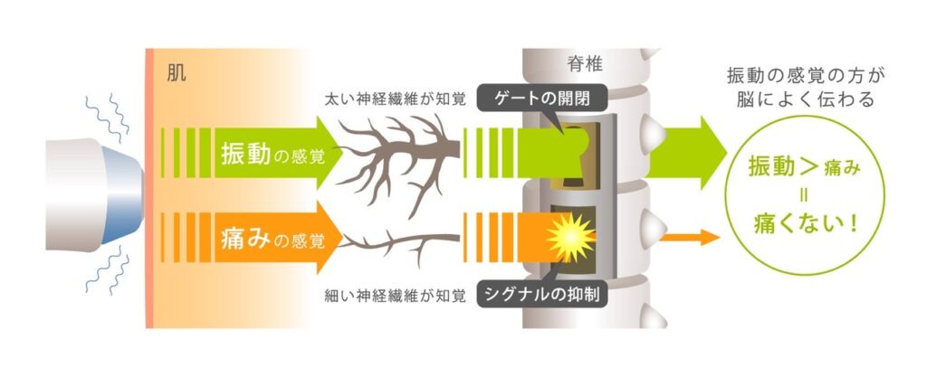 ゲートコントロール理論で熱感を緩和