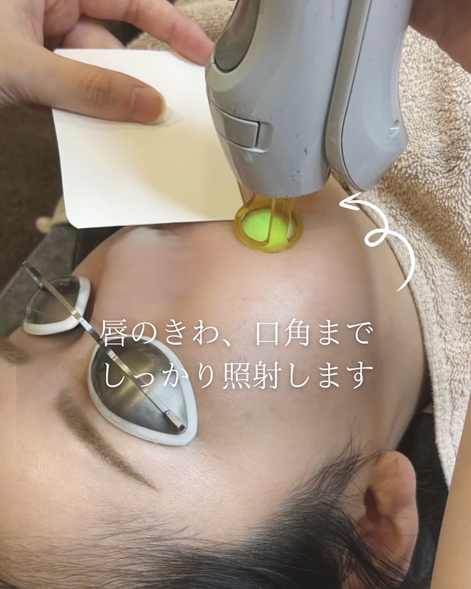 唇のきわ、口角までしっかり照射します