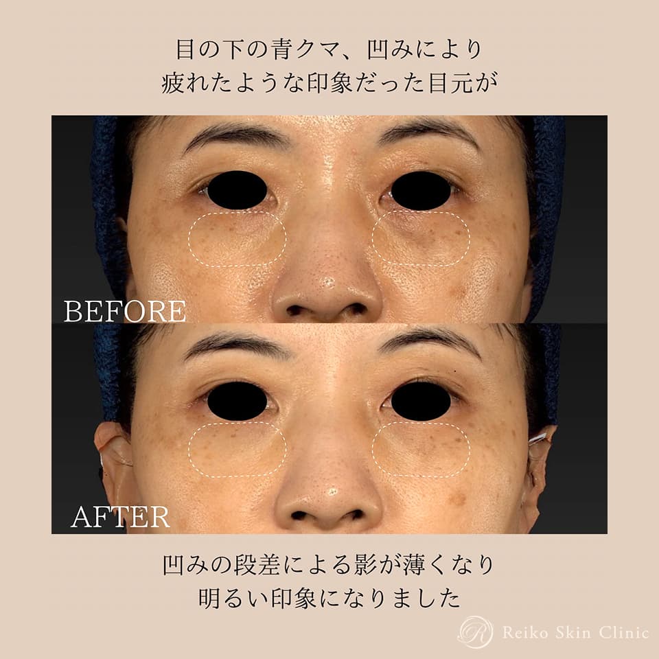 ベビーコラーゲン注入の施術症例
