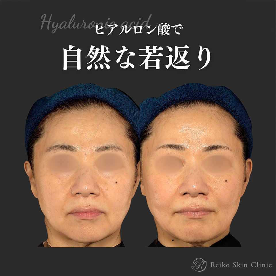 ゴルゴライン・ほうれい線ヒアルロン酸の施術症例