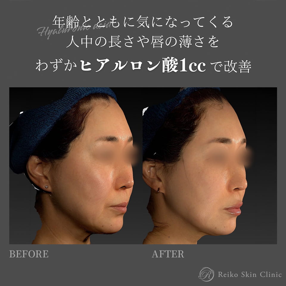 唇ヒアルロン酸(VOLBERRA 1cc)の施術症例