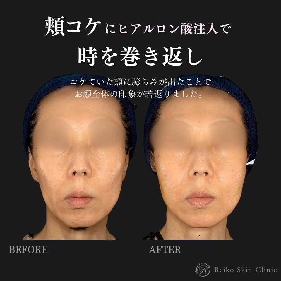 頬コケヒアルロン酸(VOLUMA 3cc)の施術症例