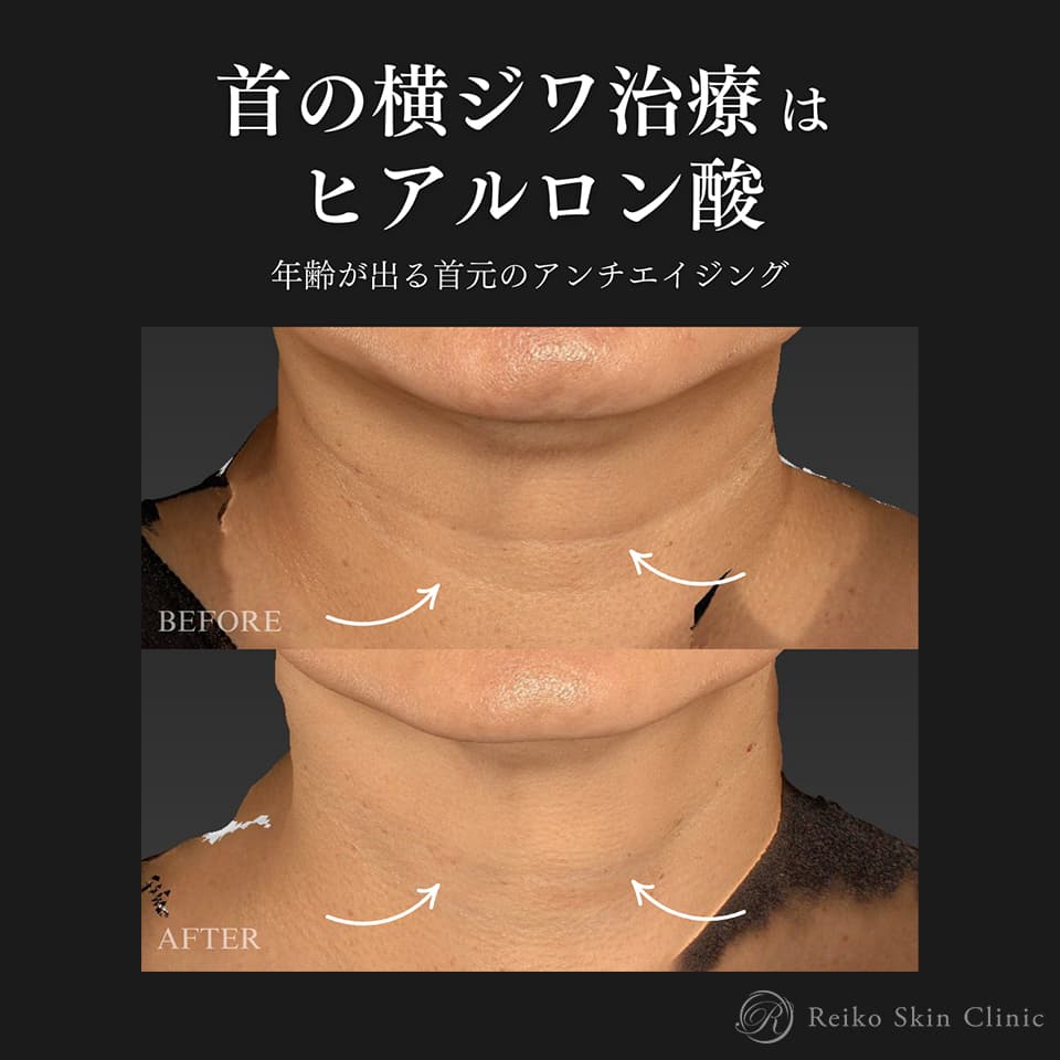 首の横ジワヒアルロン酸の施術症例