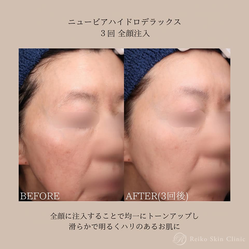 NEAUVIA HYDRO DELUXの施術症例