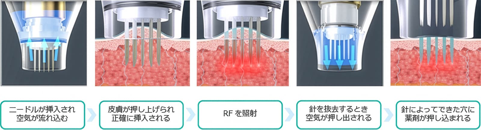 ニキビ痕、毛穴の開きへの施術