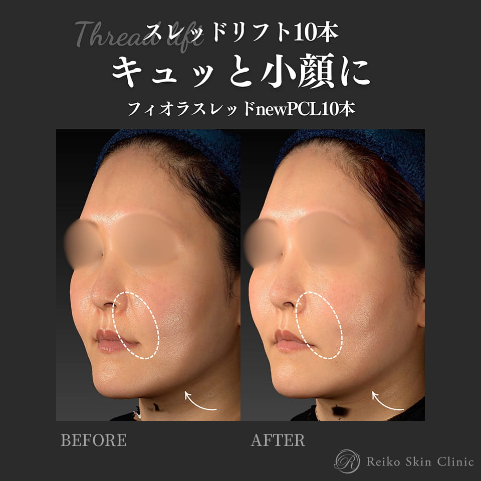 フィオラスレッドの施術症例