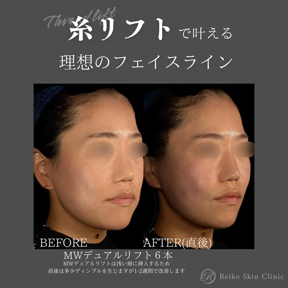 MWデュアルリフトの施術症例
